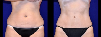 Frontal View - Tummy Tuck