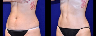 Left 3/4 View - Tummy Tuck