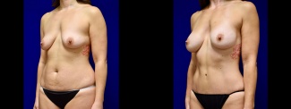 Left 3/4 View - Tummy Tuck with Breast Augmentation