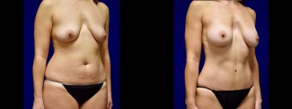 Right 3/4 View - Tummy Tuck with Breast Augmentation