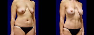 Left 3/4 View - Tummy Tuck with Breast Augmentation