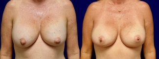 Frontal View - Breast Implant Revision