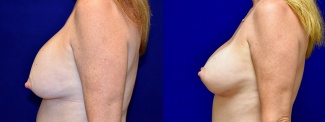 Left Profile View - Breast Implant Revision