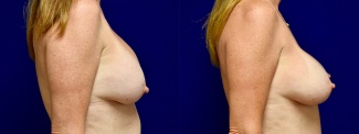 Right Profile View - Breast Implant Revision