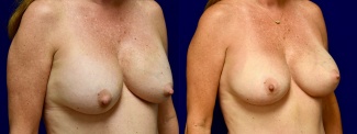 Right 3/4 View - Breast Implant Revision