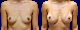 Frontal View - Breast Augmentation