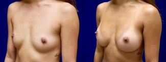 Left 3/4 View - Breast Augmentation