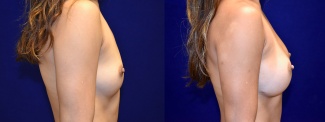 Right Profile View - Breast Augmentation