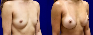 Right 3/4 View - Breast Augmentation