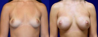 Frontal View - Breast Augmentation