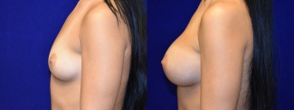 Left Profile View - Breast Augmentation