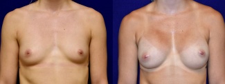 Frontal View - Breast Augmentation