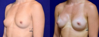 Left 3/4 View - Breast Augmentation