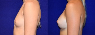 Left Profile View - Breast Augmentation