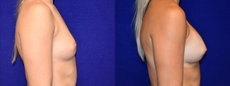 Right Profile View - Breast Augmentation