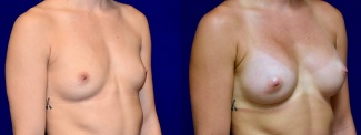 Right 3/4 View - Breast Augmentation