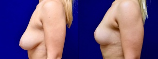 Left Profile View - Breast Reduction