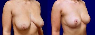 Right 3/4 View - Breast Reduction