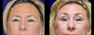 Frontal View - Browlift with Upper and Lower Eyelid Surgery