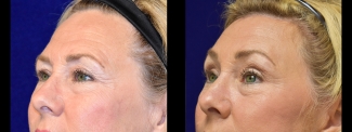 Left 3/4 View - Browlift with Upper and Lower Eyelid Surgery