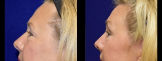 Left Profile View - Browlift with Upper and Lower Eyelid Surgery