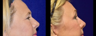 Right Profile View - Browlift with Upper and Lower Eyelid Surgery