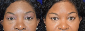 Frontal View - Lower Eyelid Surgery