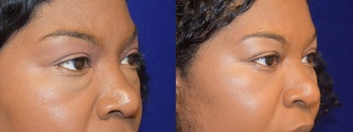 Right 3/4 View - Lower Eyelid Surgery