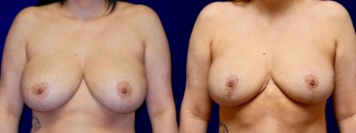 Frontal View - Breast Implant Removal with Reduction and Lift
