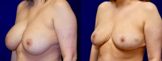 Left 3/4 View - Breast Implant Removal with Reduction and Lift