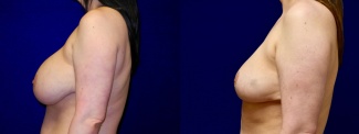 Left Profile View - Breast Implant Removal with Reduction and Lift