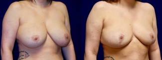 Right 3/4 View - Breast Implant Removal with Reduction and Lift