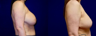 Right Profile View - Breast Implant Removal with Reduction and Lift