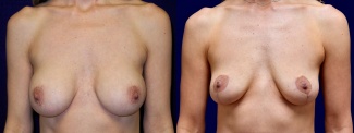 Frontal View - Breast Implant Removal with Breast Lift