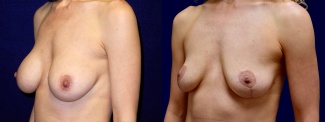Left 3/4 View - Breast Implant Removal with Breast Lift