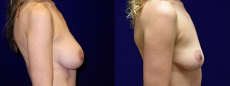 Right Profile View - Breast Implant Removal with Breast Lift