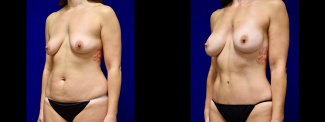 Left 3/4 View - Tummy Tuck with Breast Augmentation