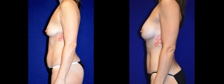 Left Profile View - Tummy Tuck with Breast Augmentation