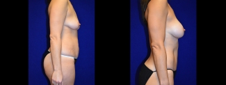 Right Profile View - Tummy Tuck with Breast Augmentation