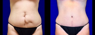 Frontal View - Tummy Tuck