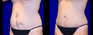 Left 3/4 View - Tummy Tuck