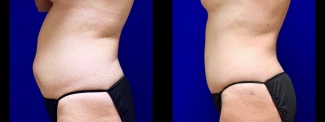 Left Profile View - Tummy Tuck