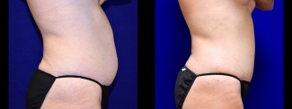 Right Profile View - Tummy Tuck with Breast Augmentation