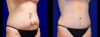 Right 3/4 View View - Tummy Tuck