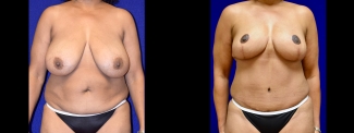 Frontal View - Breast Reduction and Tummy Tuck