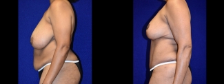 Left Profile View - Breast Reduction and Tummy Tuck