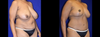 Right 3/4 View - Breast Reduction and Tummy Tuck