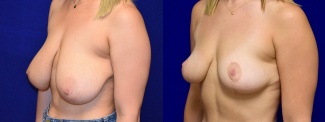 Left 3/4 View - Breast Lift