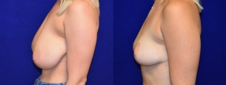 Left Profile View - Breast Lift