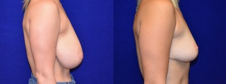 Right Profile View - Breast Lift